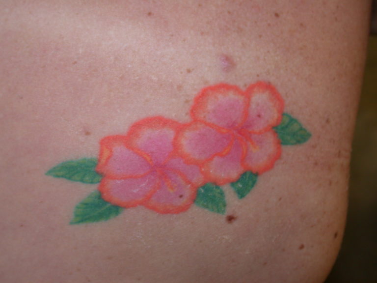 Tattoo Removal: Excision | The Cosmetic & Skin Surgery Center