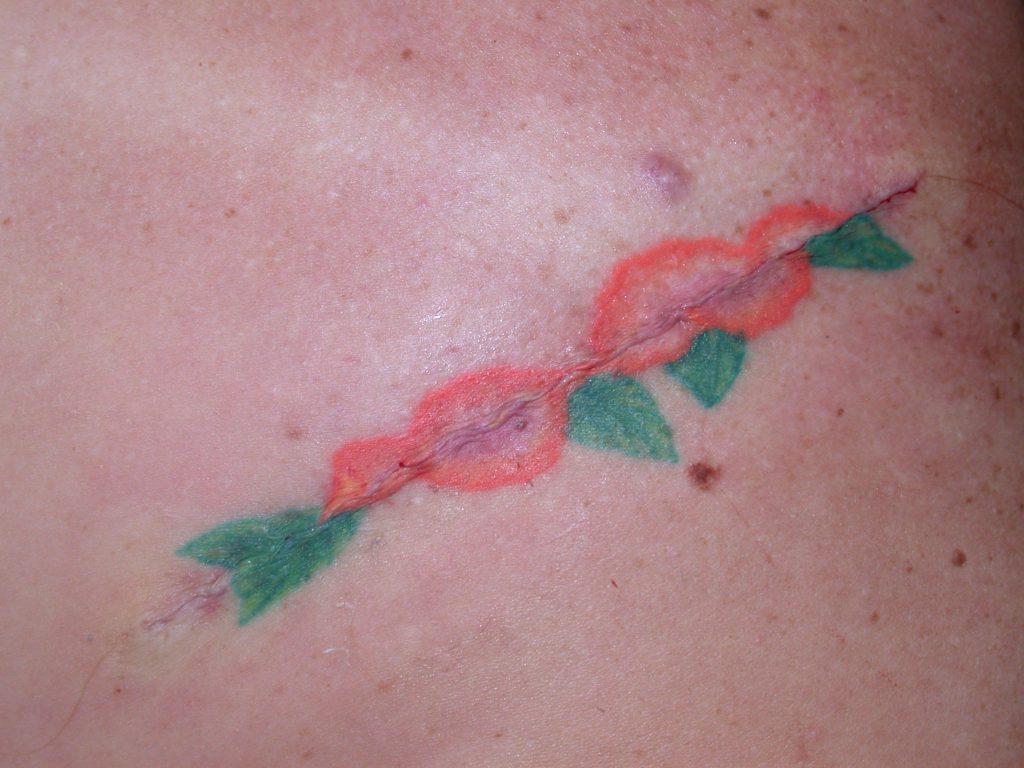 Options For Tattoo Removal Excision.html