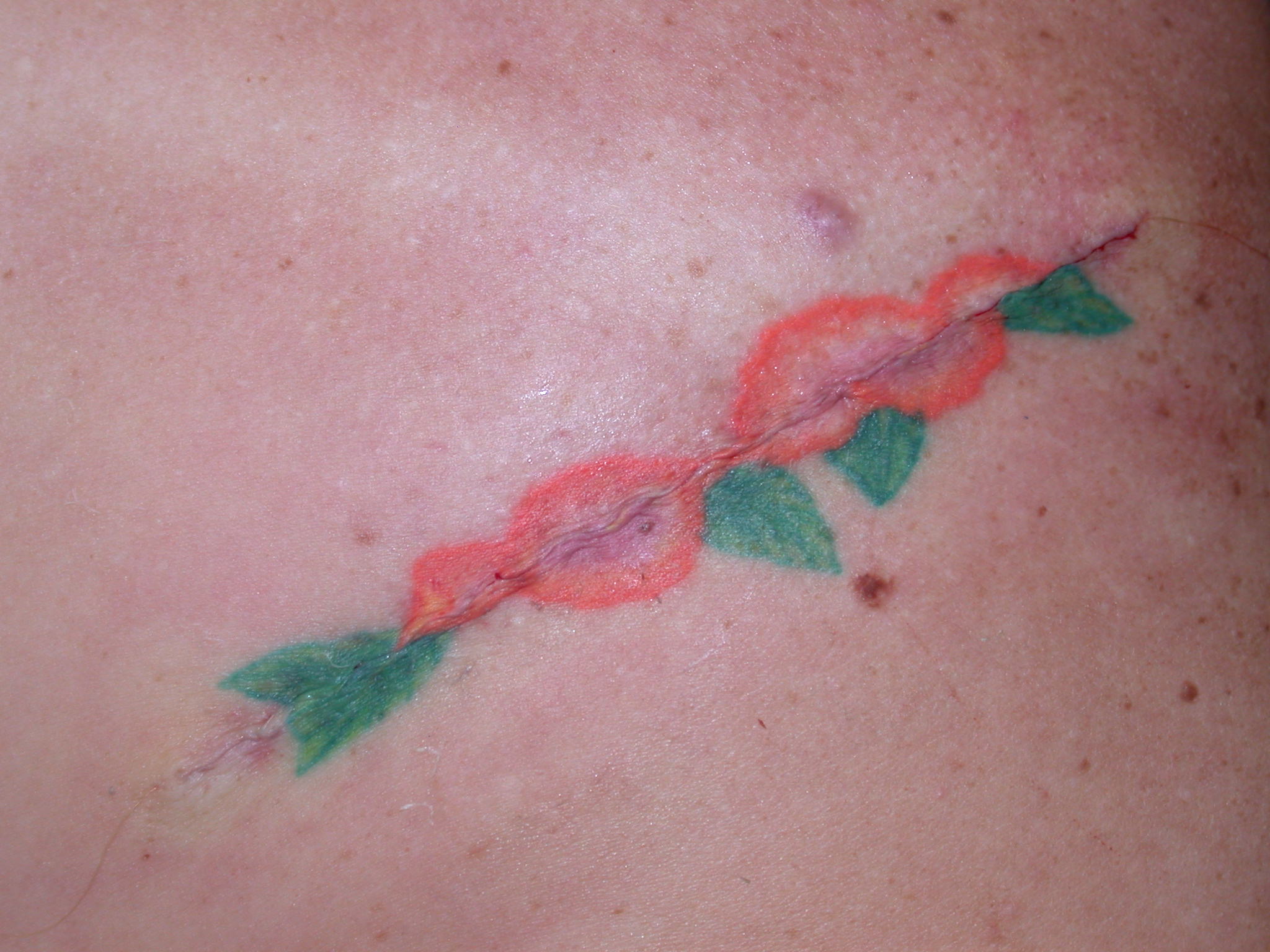 Tattoo Removal Excision The Cosmetic and Skin Surgery Center